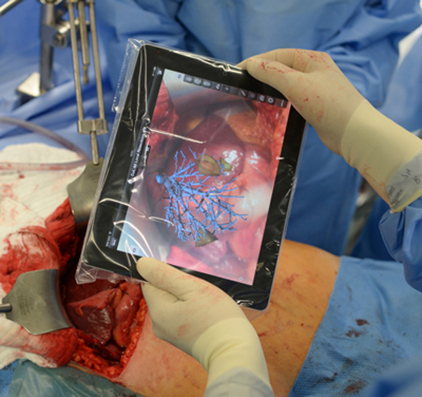 Realidad Aumentada en tablet para operaciones de higado