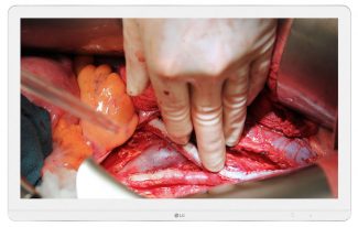 LG monitor 4k sanidad